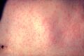 Morbillivirus measles infection.jpg
