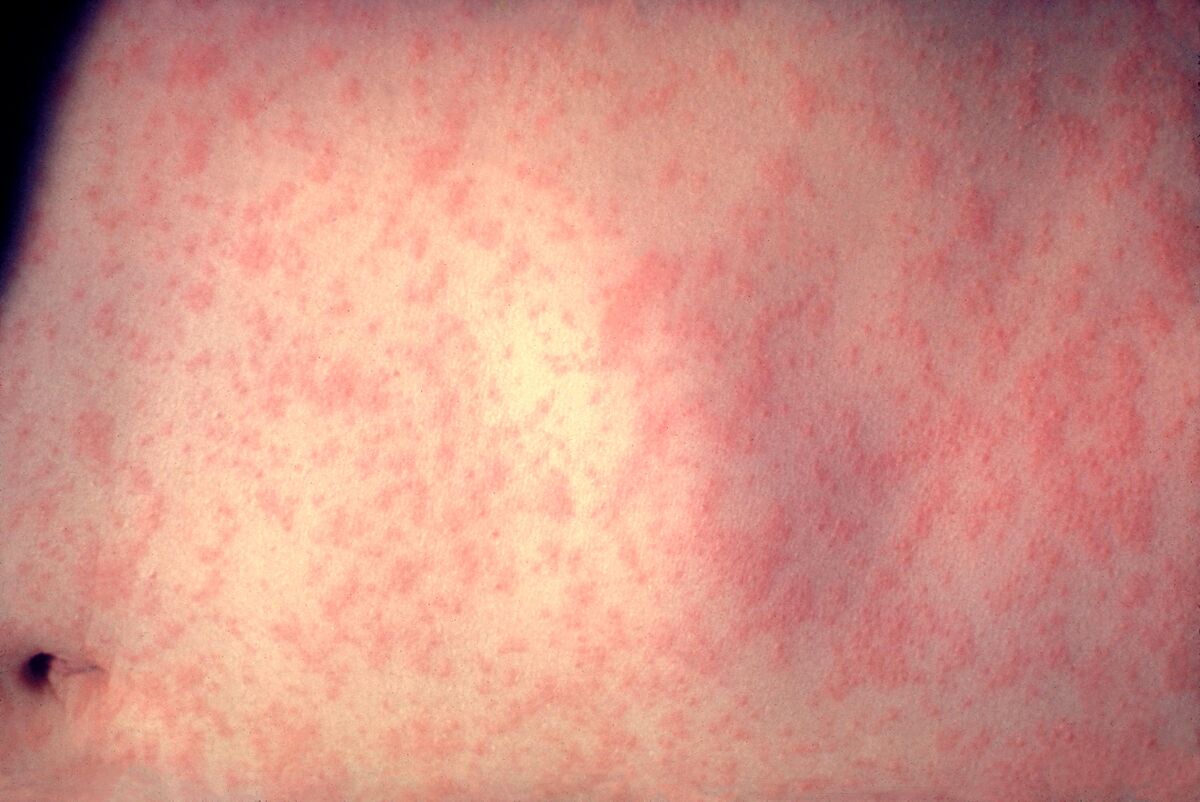 Morbillivirus measles infection.jpg