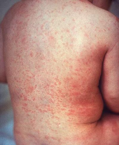 Rash of rubella on back (crop).jpeg